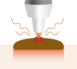 CO2レーザーの照射のイメージ図