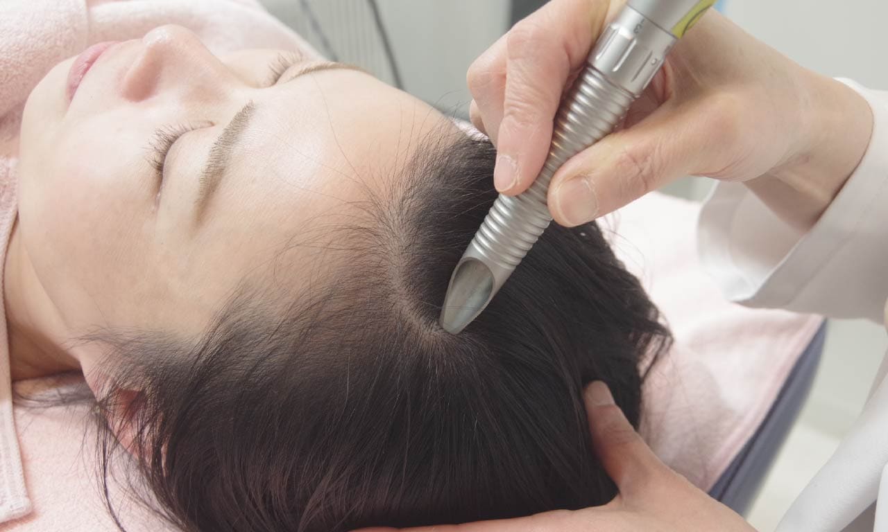 女性のうす毛の治療写真