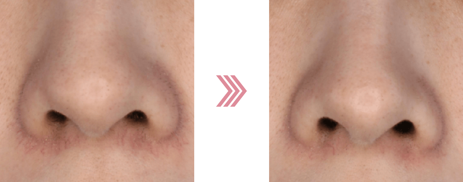 Vビーム毛細血管治療（鼻周囲）の治療前後の写真